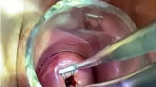 Запеченный расширитель входит через эндоцервикальное зеркало - порно видео